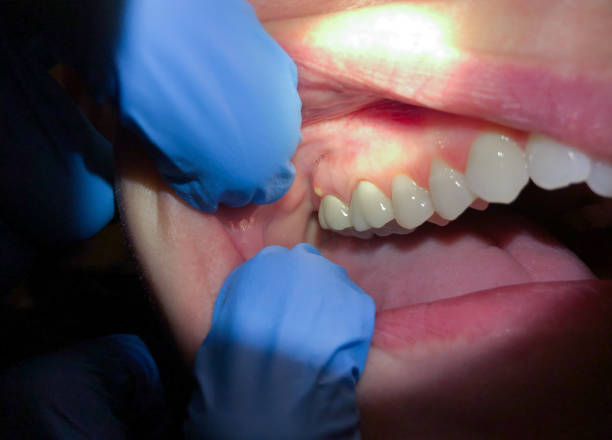 Best Emergency Tooth Extraction  in Easton, MD