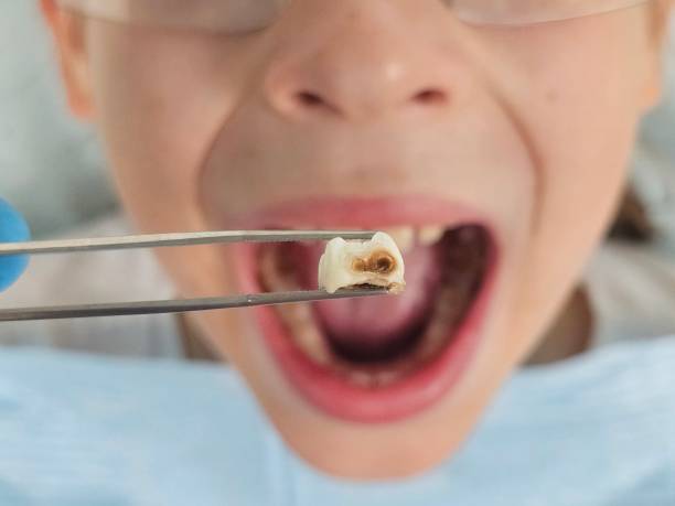 Urgent Tooth Repair in MD